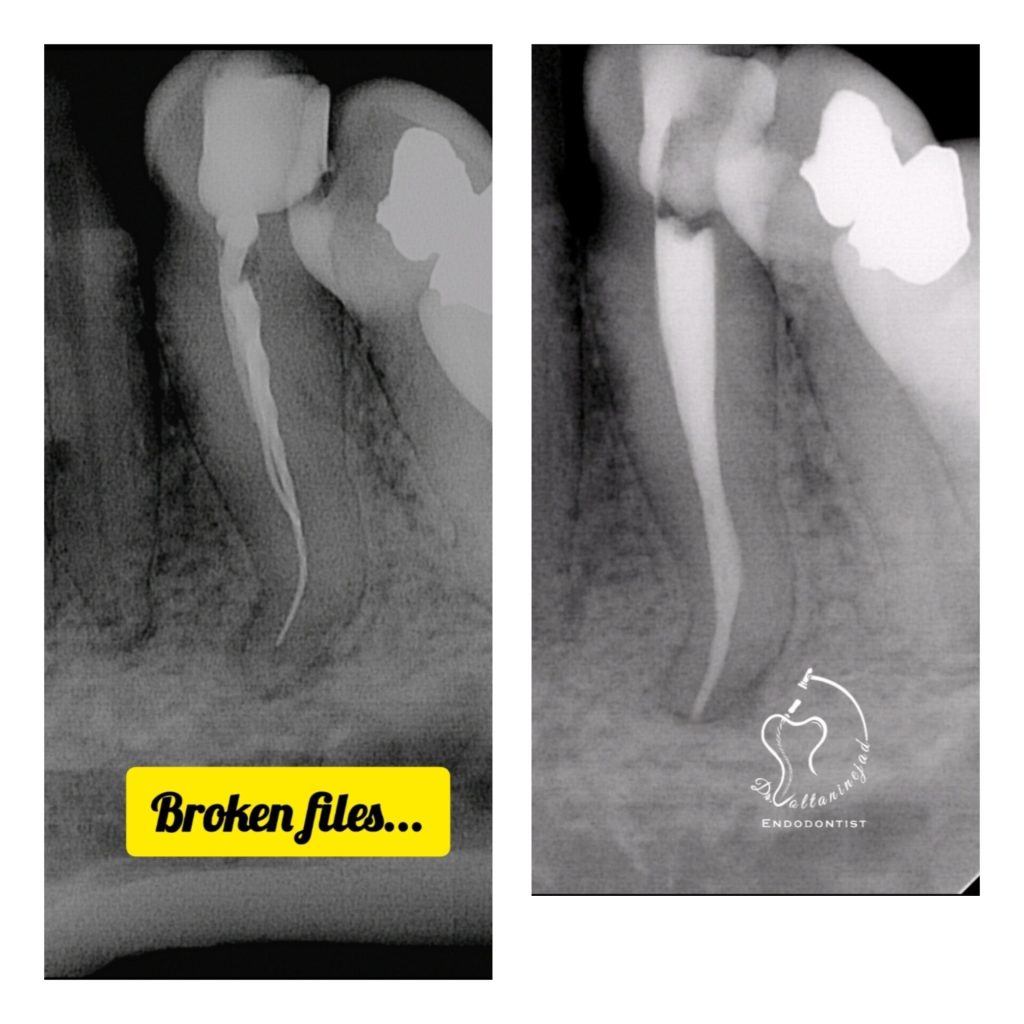 خارج کردن فایل شکسته