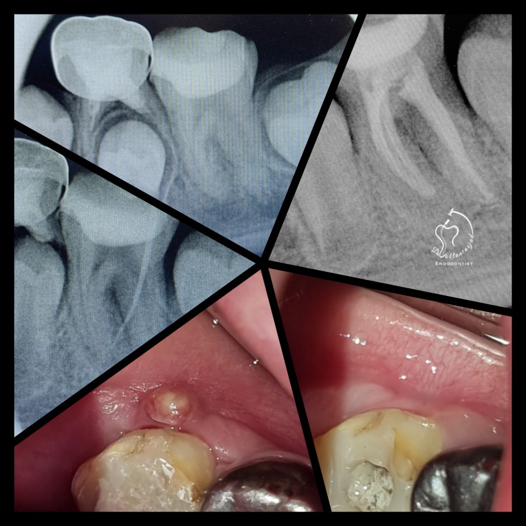 درمان ریشه دندان نابالغ