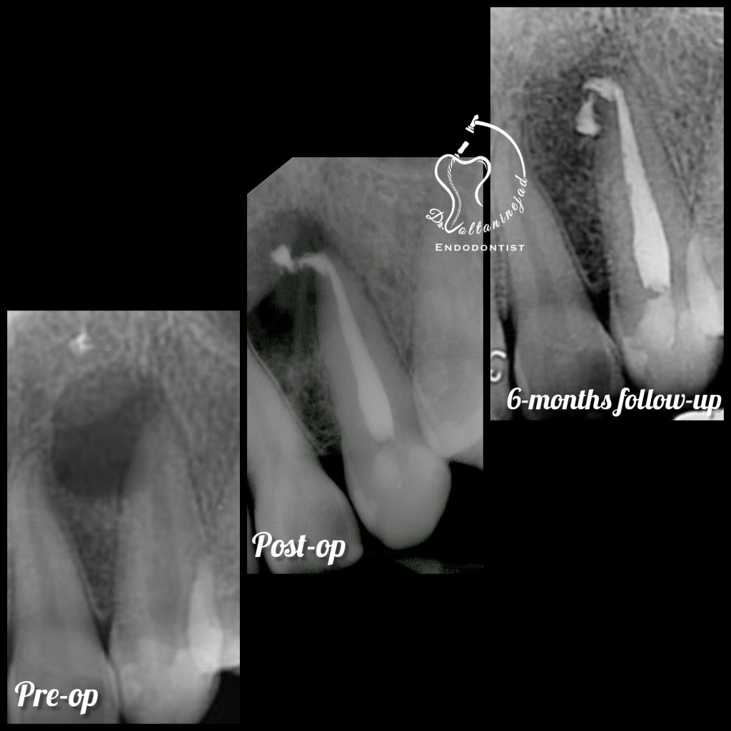 درمان ریشه دندان کانین