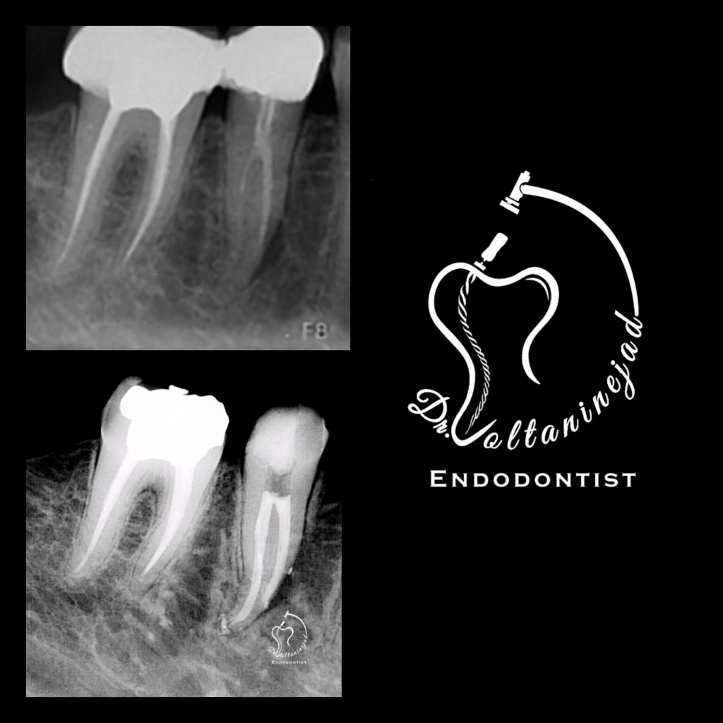 درمان ریشه مجدد پرمولر