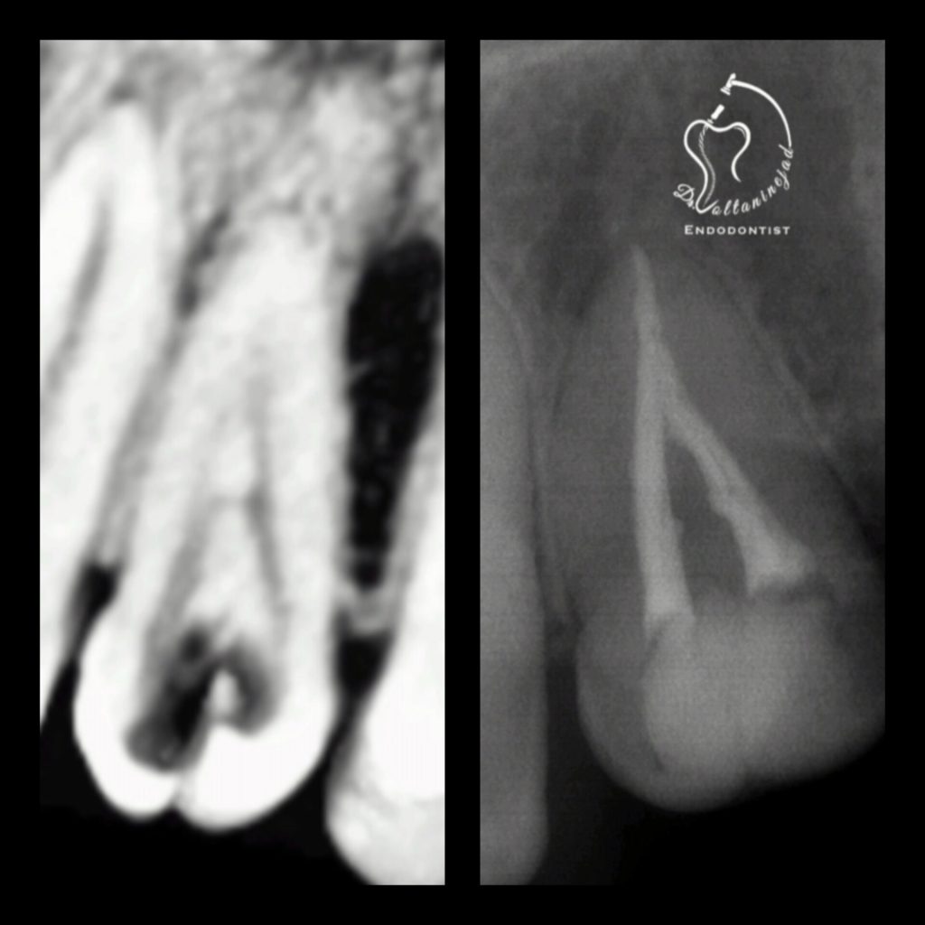 درمان ریشه دندان نادر